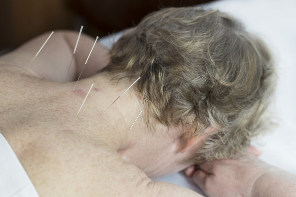 Senior Care in Chadds Ford PA: Acupuncture