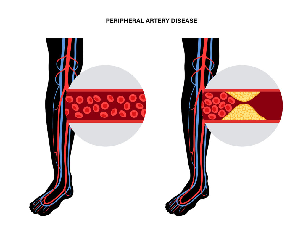 Home Health Care in Berwyn PA: Peripheral Artery Disease