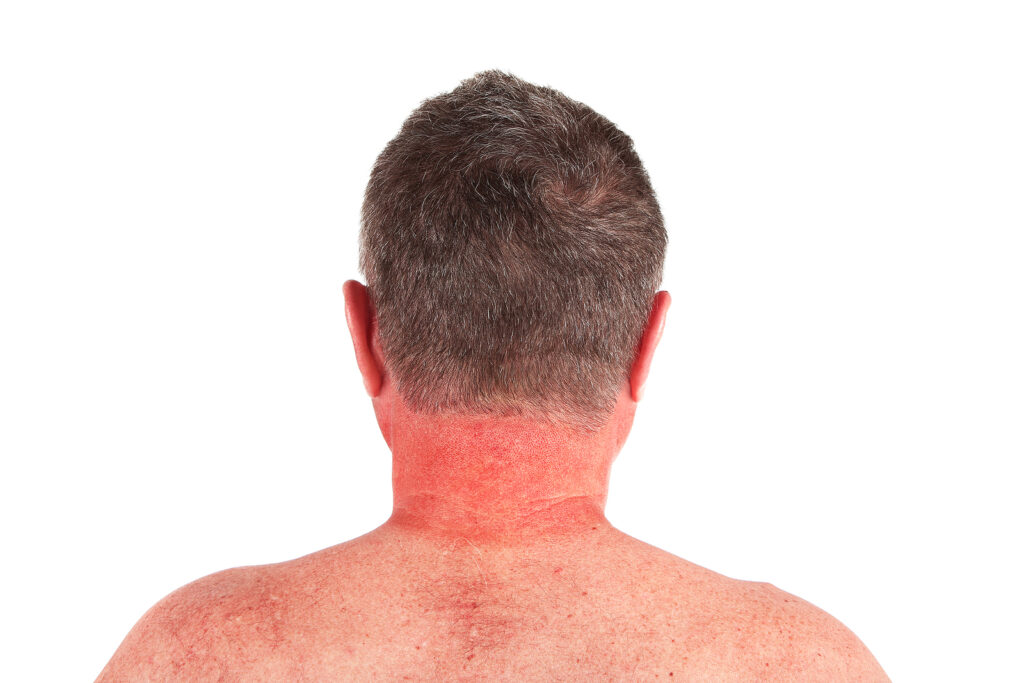 Caregiver in Media PA: Sunburn